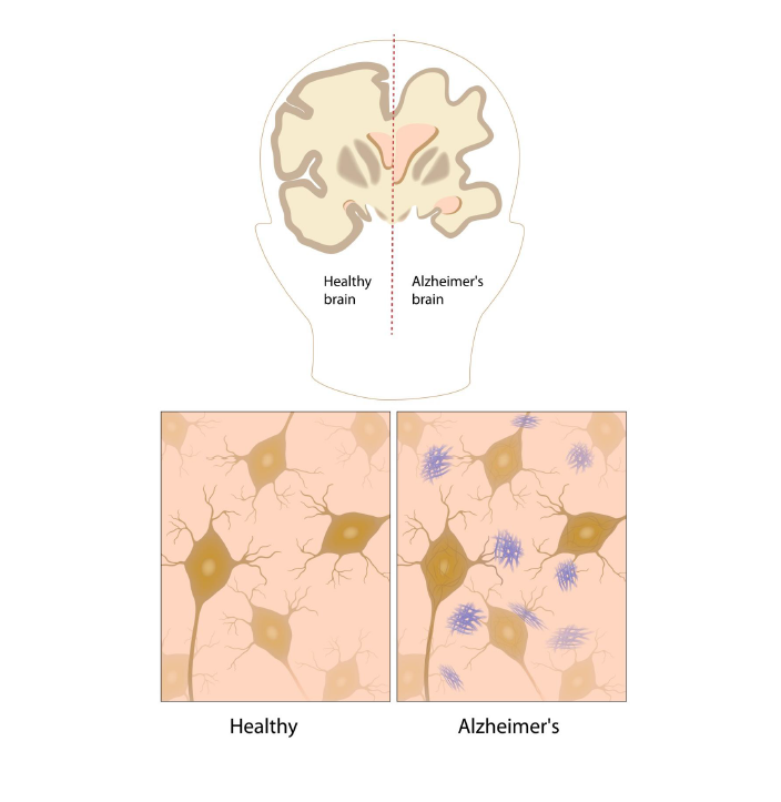 Alzheimer’s disease